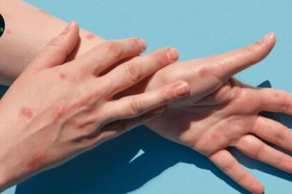 Two Confirmed and a Suspect Case of Mpox Reported in Lahore