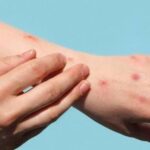 Lahore’s Mayo Hospital Confirms 21 Mpox Cases in Six Months