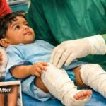 PHHF Expands Initiative to Offer Free Clubfoot Surgery for Children