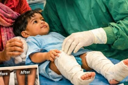 PHHF Expands Initiative to Offer Free Clubfoot Surgery for Children