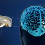 China Approves NEO Brain Implant for Paralysis Recovery