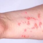 Sindh Reports Nine Deaths Amid Rising Monkeypox Cases