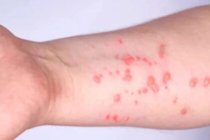 Sindh Reports Nine Deaths Amid Rising Monkeypox Cases