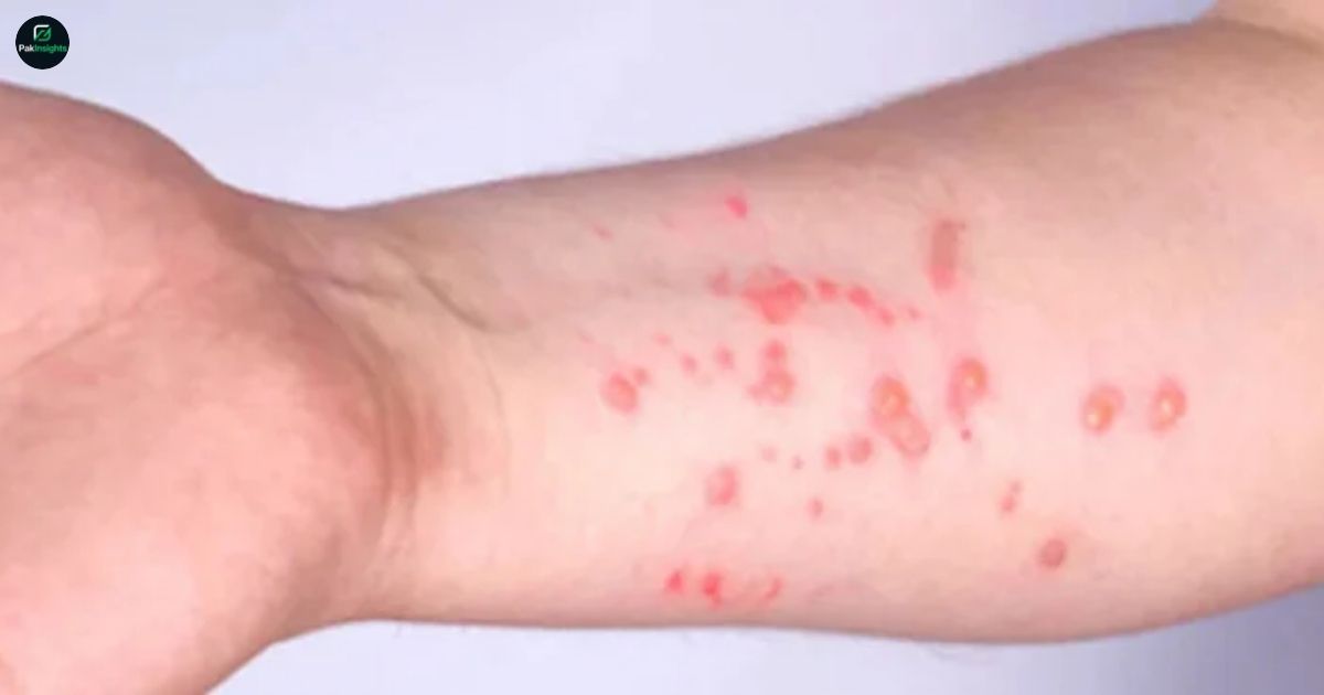 Sindh Reports Nine Deaths Amid Rising Monkeypox Cases